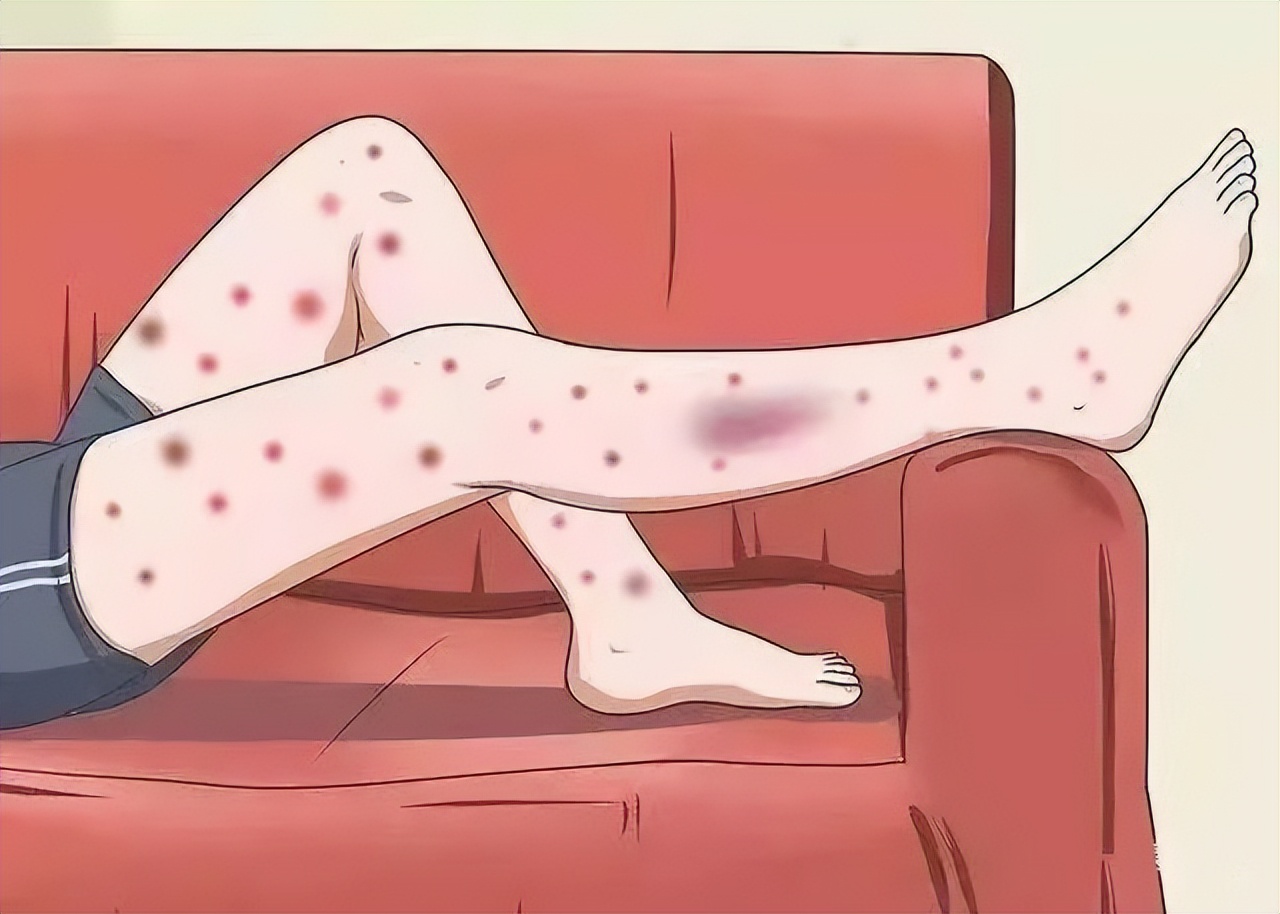 什么是过敏性紫癜肾炎,什么是过敏性紫癜能痊愈吗