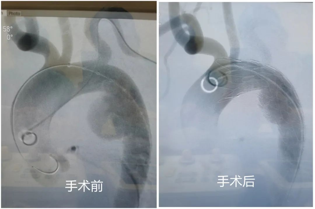 206斤小伙查出胸主动脉瘤如拳头大，专家提醒：胖墩墩”胸口藏“雷”几率高，88%爆雷后2小时内致命