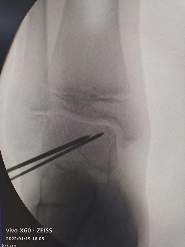 踝关节软骨损伤与踝关节炎区别,踝关节距骨软骨损伤怎么保护的