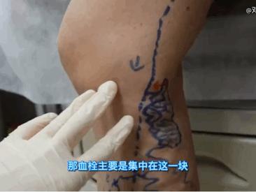 腿上起红肿大包疼,快告诉爸妈碰到这些人要当心