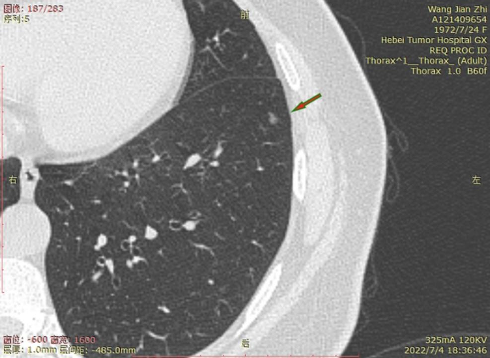 首次发现磨玻璃结节要吃药消炎吗,磨玻璃结节警惕合并占位