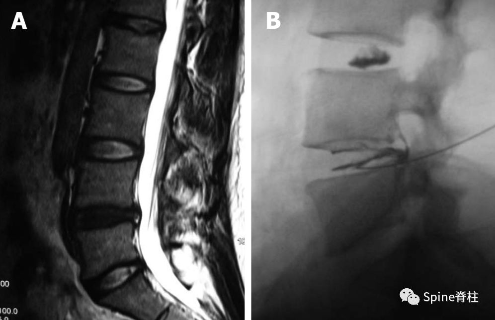 因腰椎问题导致的腰痛,慢性腰骶部疼痛
