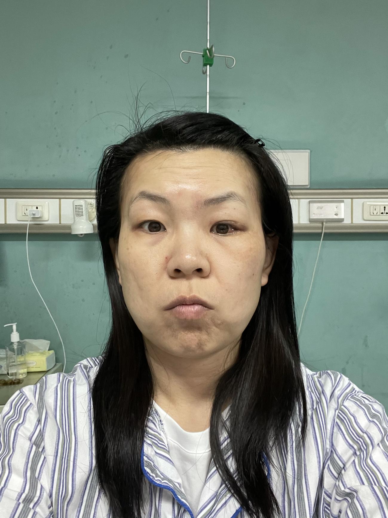 眼眶蜂窝织炎看病经验分享,患了急性眼眶蜂窝织炎如何治疗