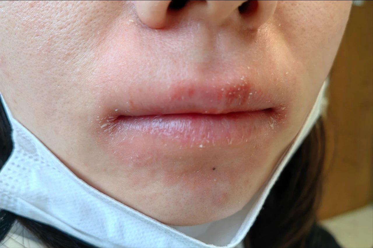 面部皮炎的症状和治疗方法,面部皮炎是怎么回事