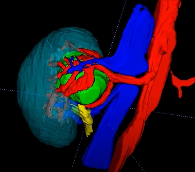 【协和医疗】高难度！泌尿外科朱绍兴教授团队高超“组合拳”完成肾肿瘤保肾手术