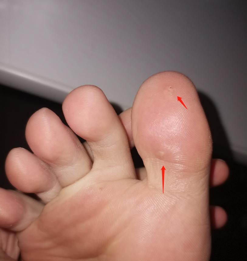 怎样辨别鸡眼和跖疣,如何辨别鸡眼和跖疣区别