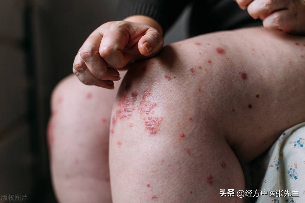 慢性湿疹一年多：中医调和营卫，健脾化积治愈