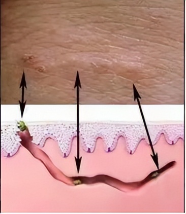 疥疮会引起腹痛吗,灼热疼痛怎么回事