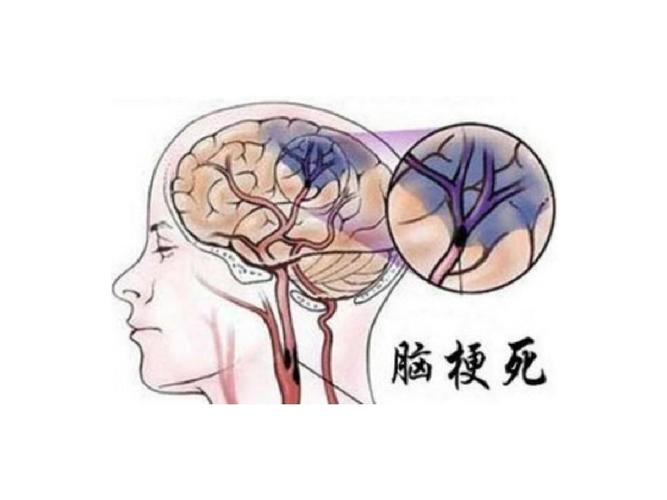 年轻人脑梗死是什么原因造成的,脑梗死是高压还是喝酒导致的