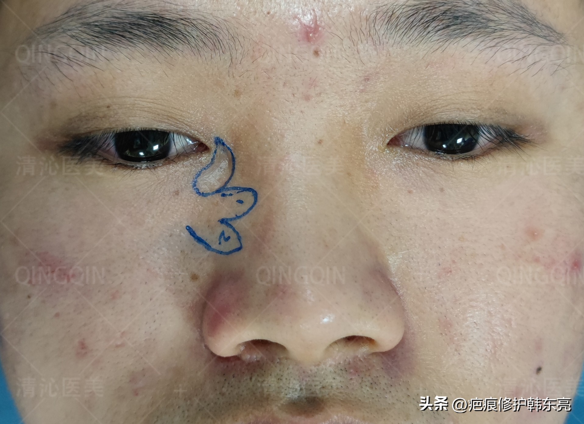 疤痕修复一次需要多少钱,上海九医院疤痕修复价目表2021