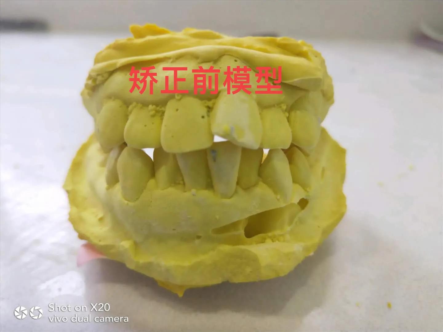 牙齿矫正需要多少钱呢前后对比图,牙齿矫正最多需要多少钱