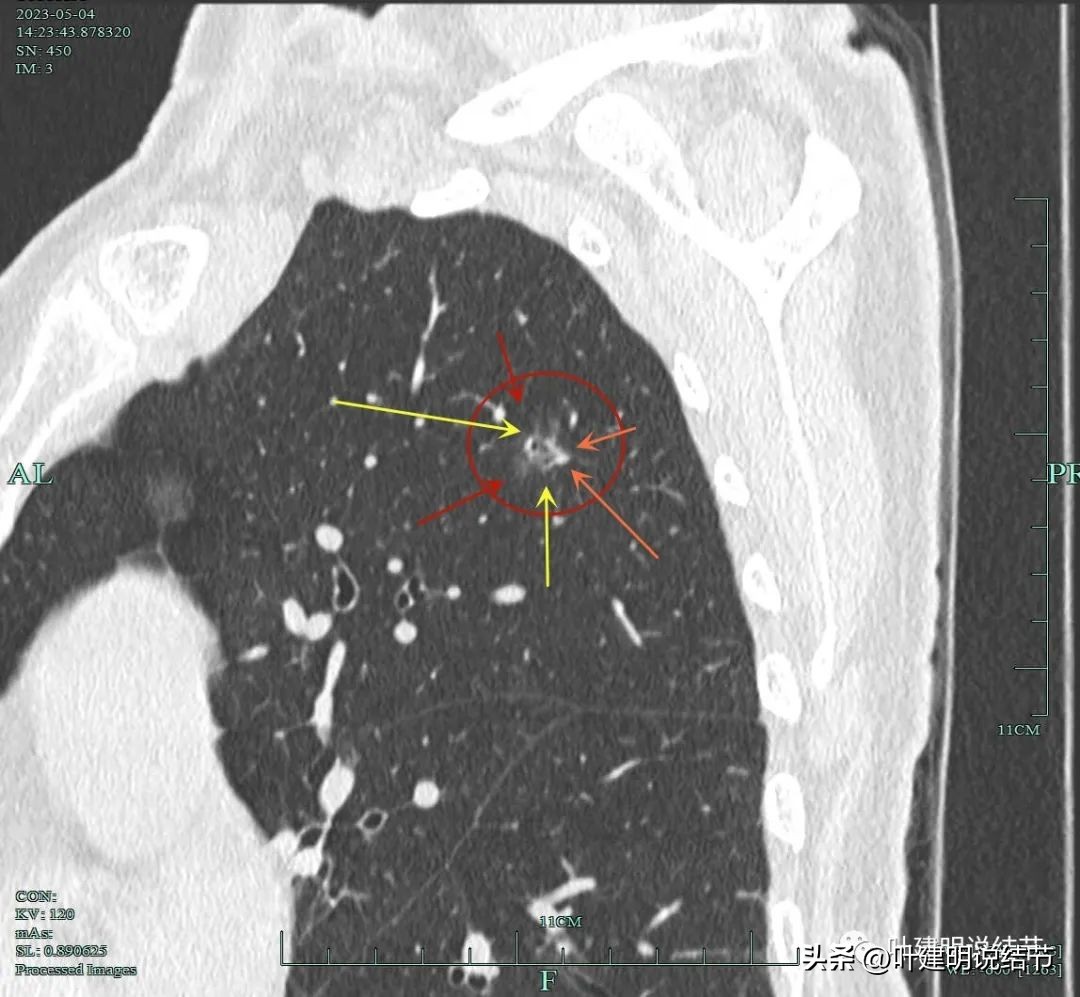 肺楔形切除肺功能降低,肺楔形切除需要缝合吗