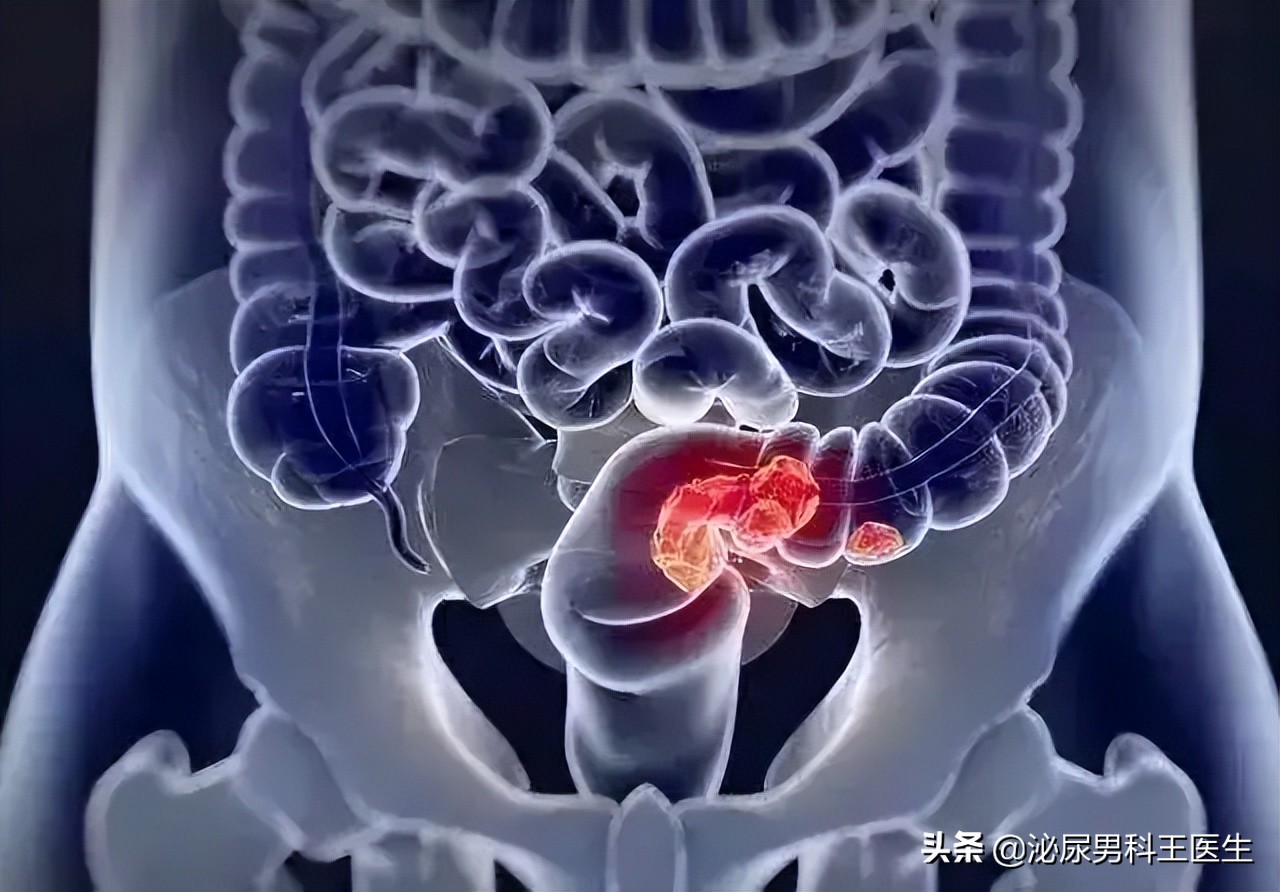 直肠癌的6个早期症状是一起出现,直肠癌出现便秘早期还是晚期