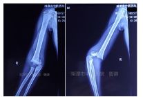 肱骨骨折取钢板怎样恢复,肱骨近端骨折切开复位内固定术