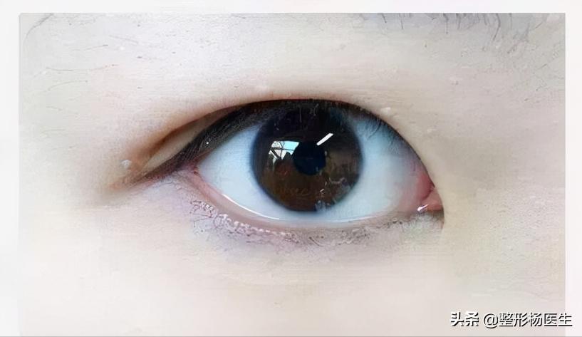 肿眼泡适合做埋线双眼皮吗,贴双眼皮贴还是肿眼泡可以埋线吗