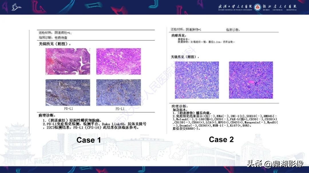 阴道肉瘤症状,阴道肉瘤的早期症状