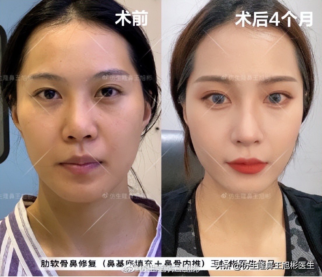 鼻翼缩小可以改善鼻翼缘后缩吗,鼻翼肥大如何正确改善