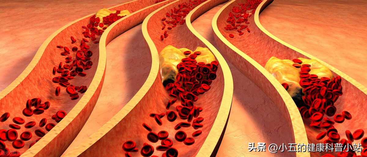 血府逐瘀丸对心绞痛有作用吗,活血化瘀冠心病药方