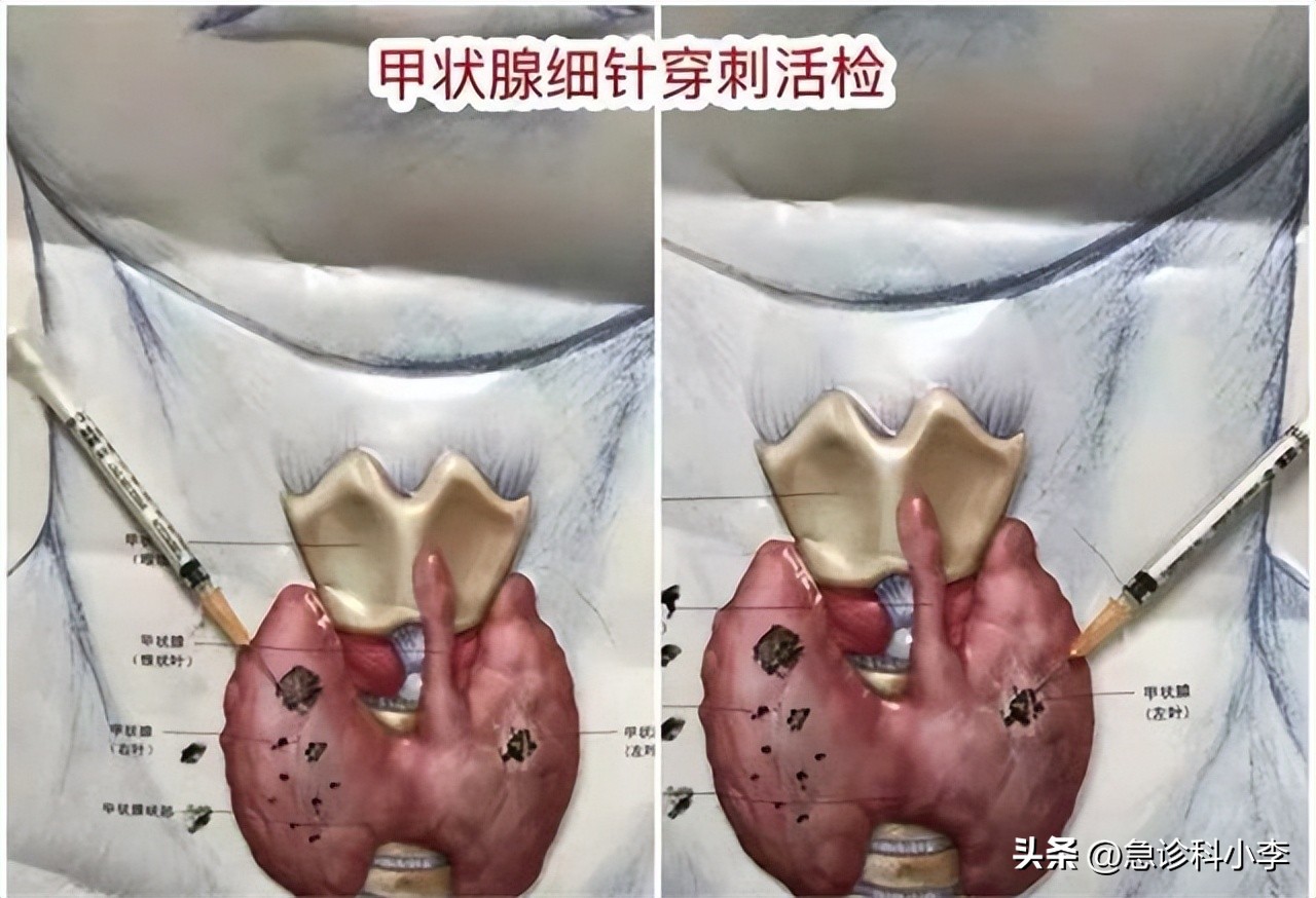 甲状腺实性结节4a癌变几率有多大,长了甲状腺结节癌变的几率有多大