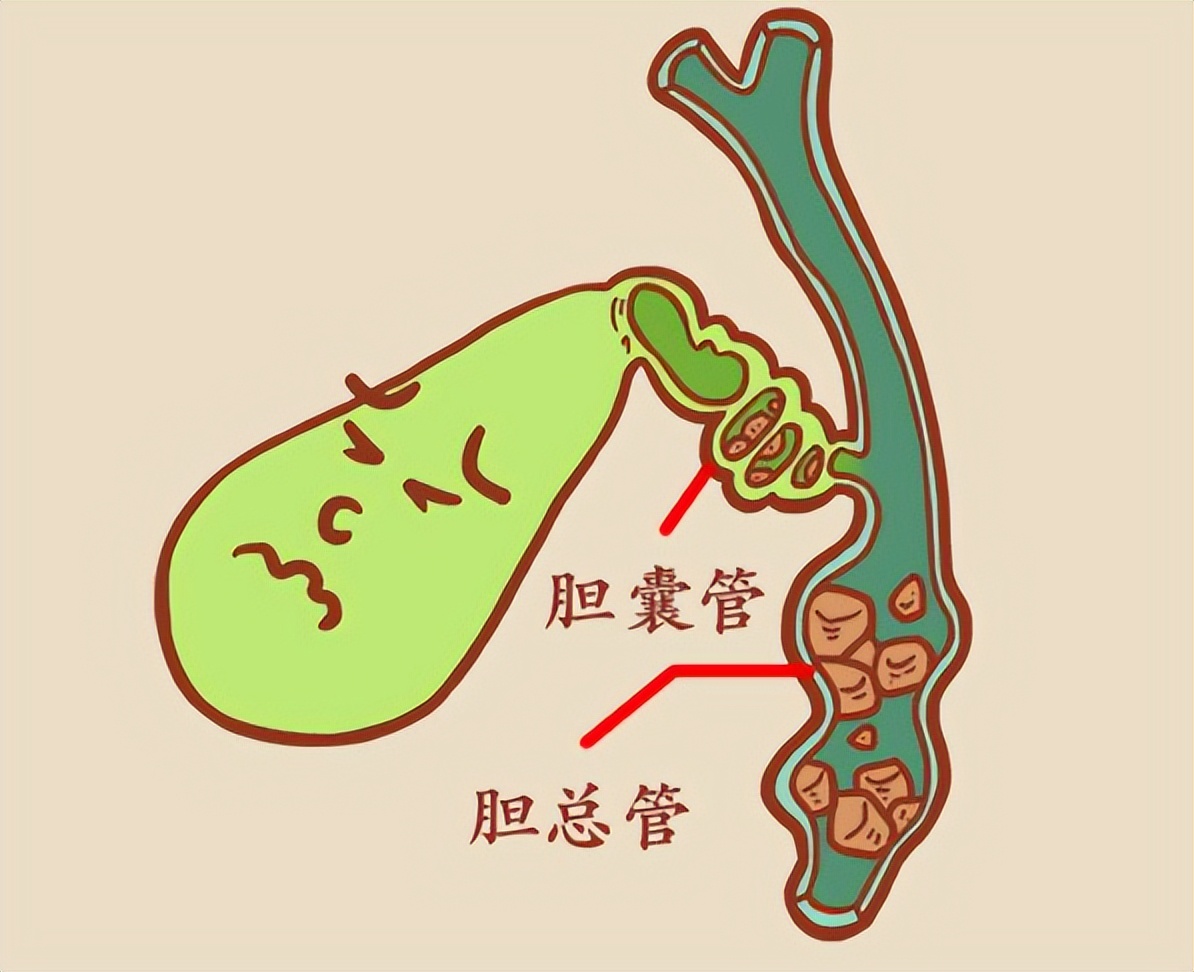 胆囊息肉切除后遗症怎样才能恢复,手术切除胆后有什么影响