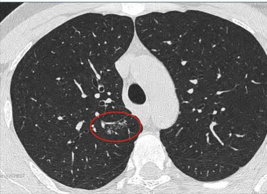 磨玻璃结节9*8mm建议随访,8mm磨玻璃结节一年没长