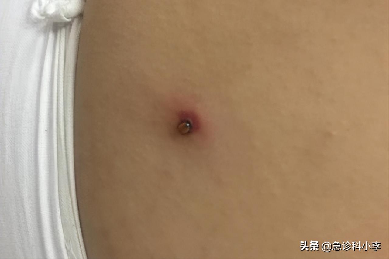 蜱虫咬人死亡率多少,蜱虫咬后死亡率新闻