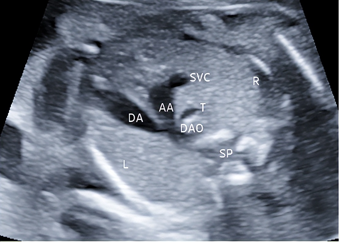 孕晚期i级产前超声检查是什么,孕中期超声产前检查