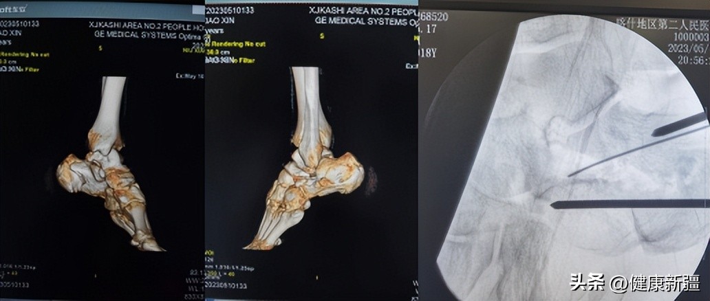 微创治疗搞定跟骨粉碎性骨折!
