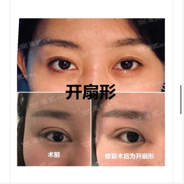 内眦赘皮用手术吗,内眼角内眦赘皮矫正不做手术