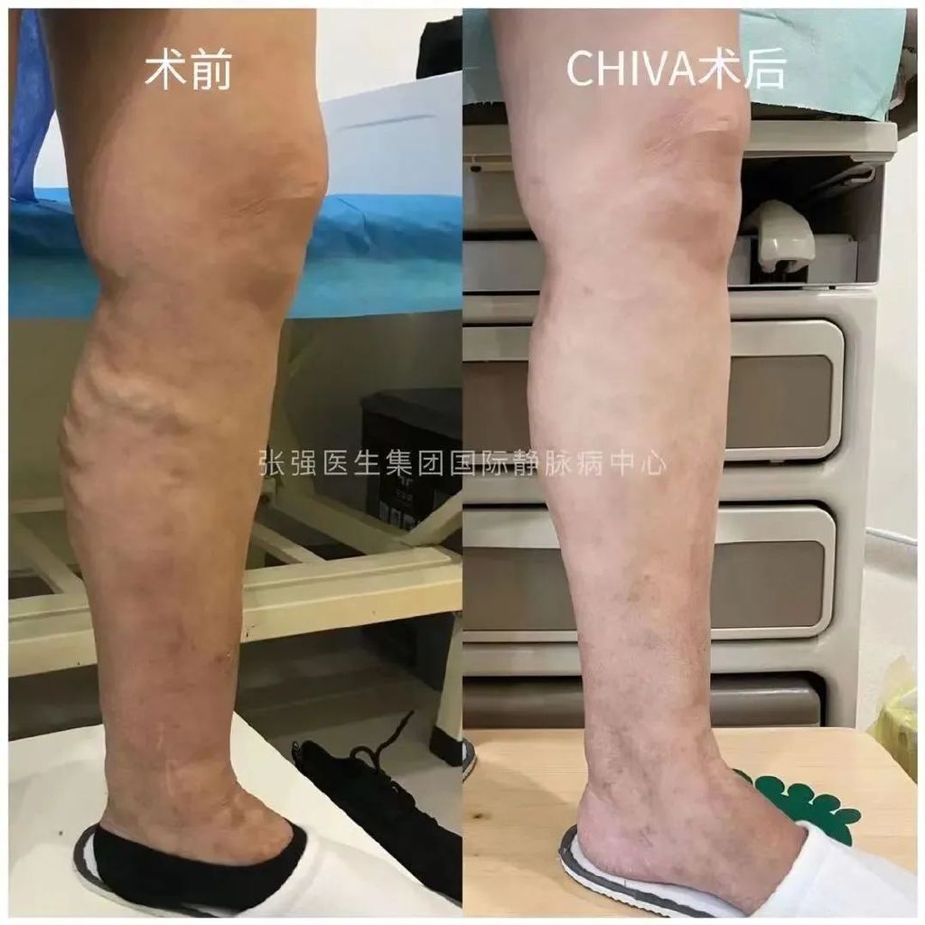 静脉曲张可以根治吗,静脉曲张能治好吗