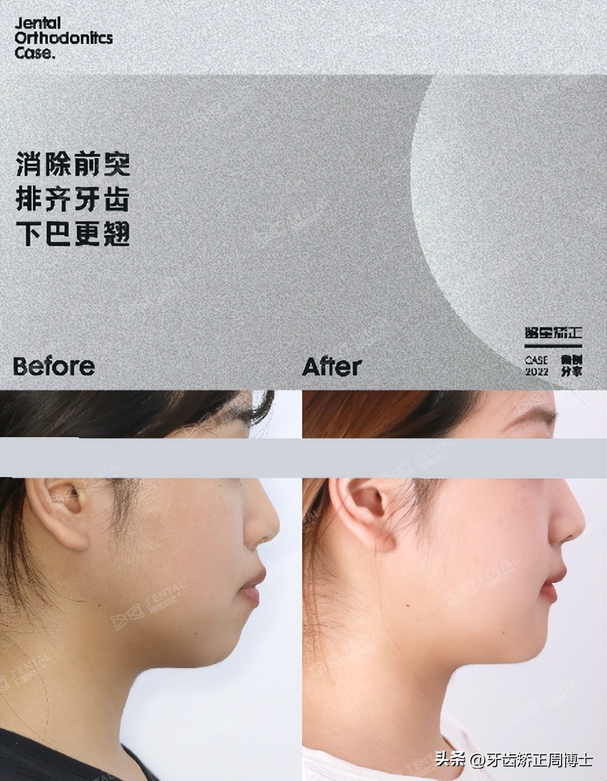 低角面型下巴前倾正畸案例,露龈笑嘴凸下巴后缩