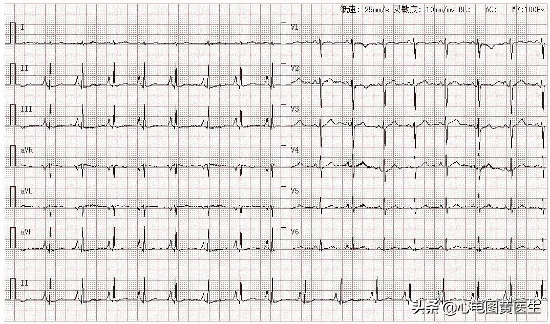 心电图读图注意事项,心电图读图练习软件