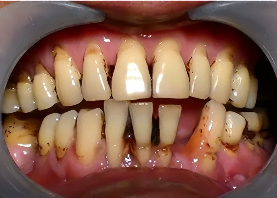 牙齿美白神器真的靠谱吗,牙齿美白产品测评真实有效