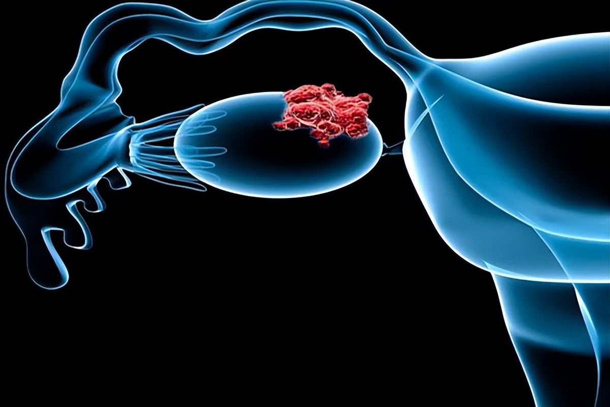 总跑厕所一般是什么病,一直小便是得了卵巢癌吗