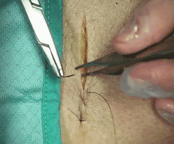 外科缝合技巧你熟练吗,外科缝合术的操作步骤