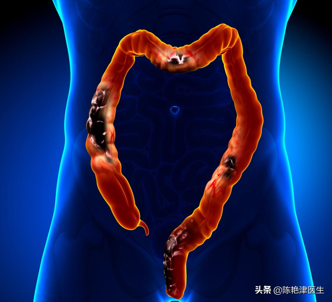 肠息肉是肠癌最大的祸根,肠息肉有癌变风险中医怎么预防