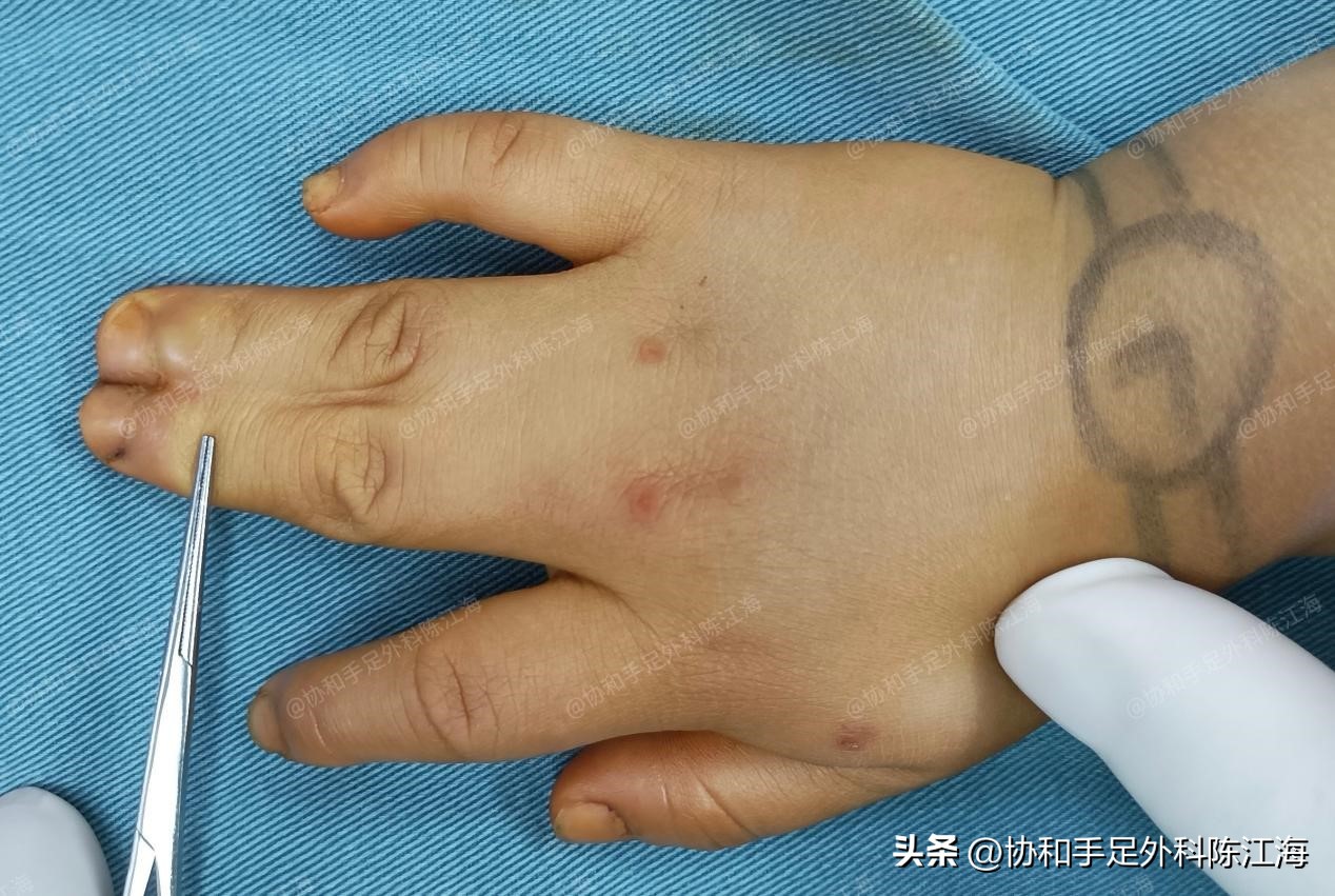 小孩多指并指免植皮新技术,儿童并指零植皮新方法