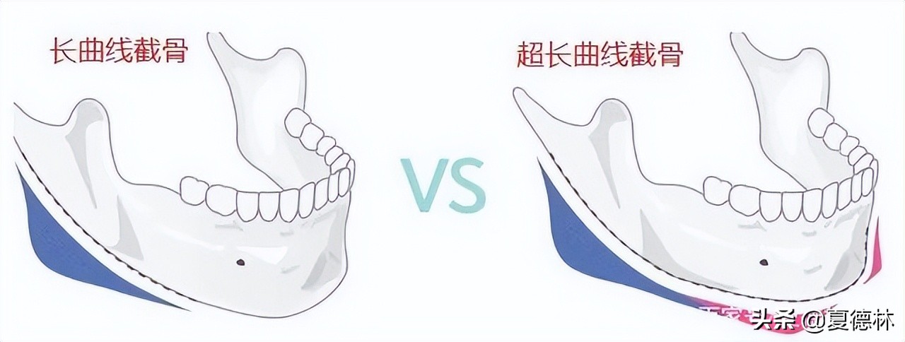 削骨和磨骨区别后遗症,削骨和磨骨的区别和危害