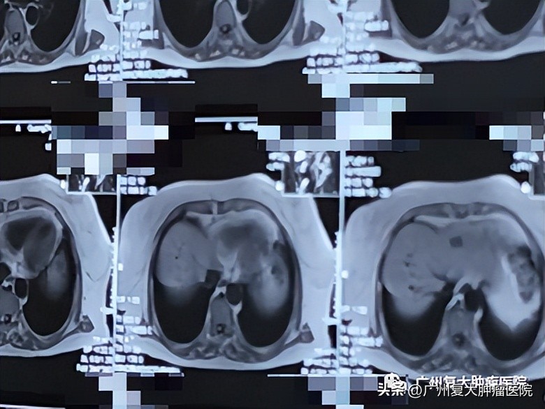 肝肿瘤靠近心脏，微波如何消融？