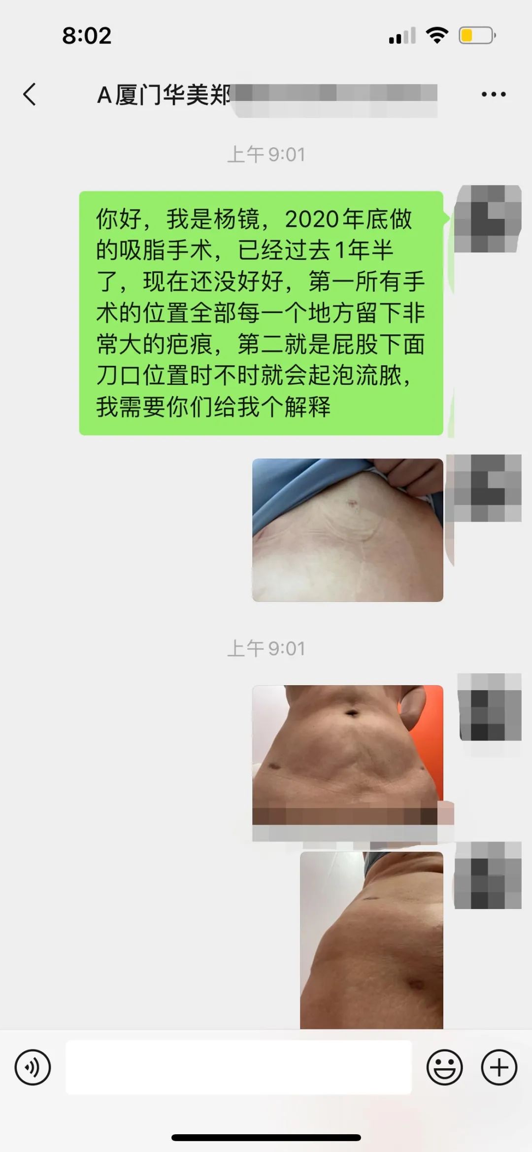 愁！花4万多元抽脂，留下12个疤，女子多次投诉厦门华美医疗