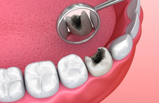 给孩子看牙的17个小妙招,给小孩儿看牙