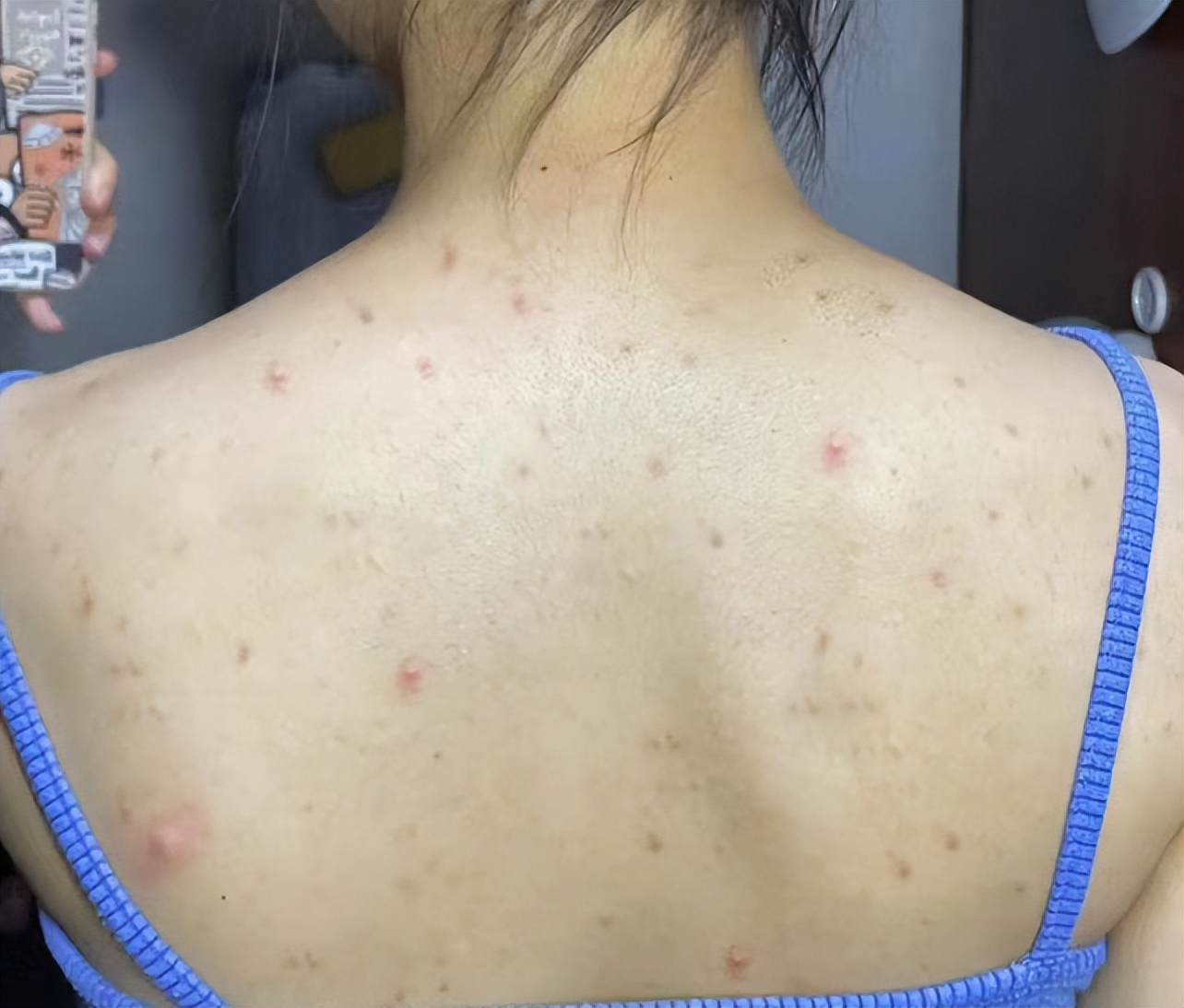 脓包型痘痘祛痘,满脸痘痘痘印痘坑去哪看