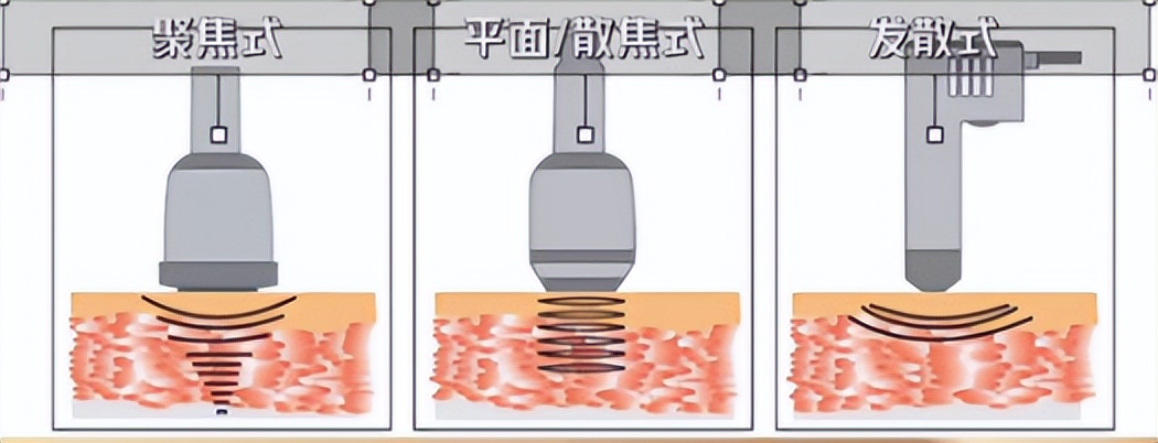 腰背痛治疗神器,冲击波治疗腰腿痛视频