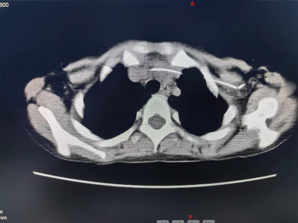 picc拔管遇导管断裂如何处理,picc导管断裂的影像表现