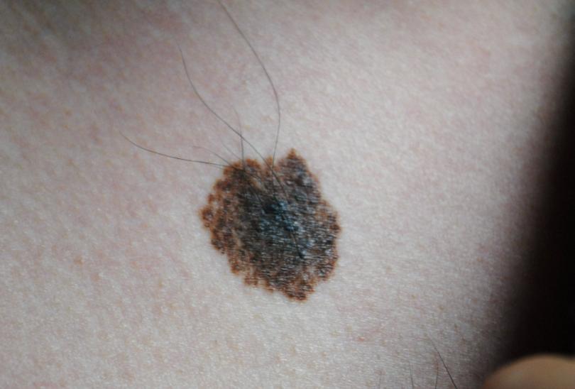 长在什么位置的痣易癌变,身上的痣出现4个变化引起重视