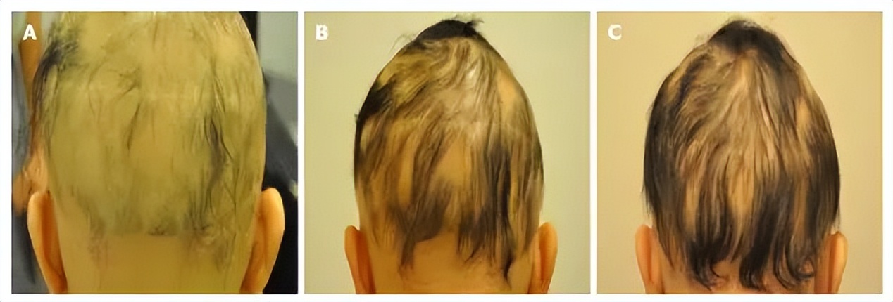 秃头康复,秃头可通过头疗生发吗
