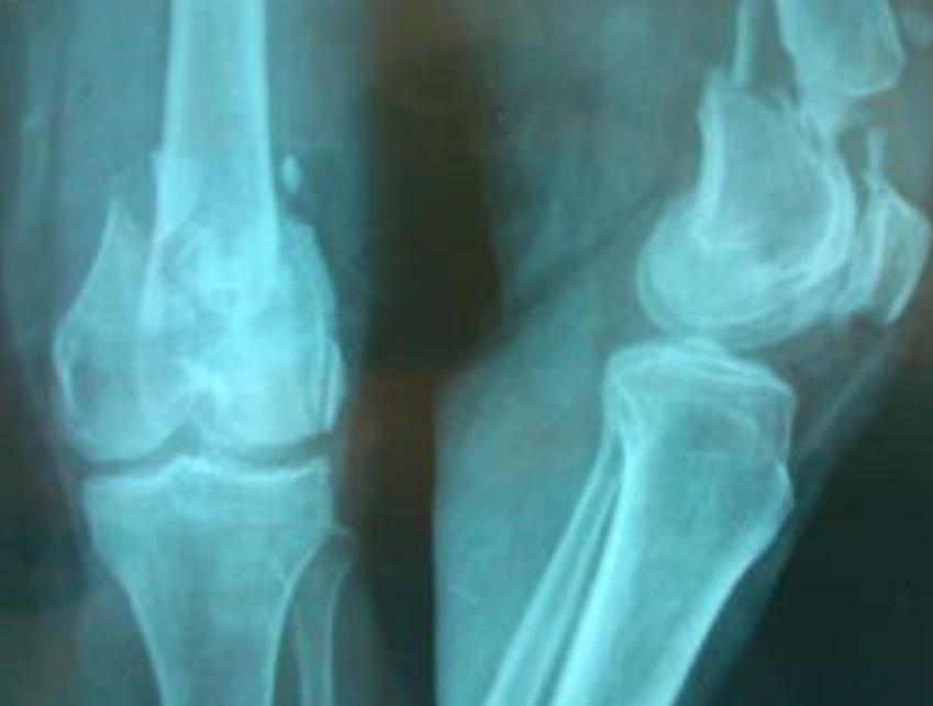 股骨骨折怎样手术,股骨骨折最佳手术方案