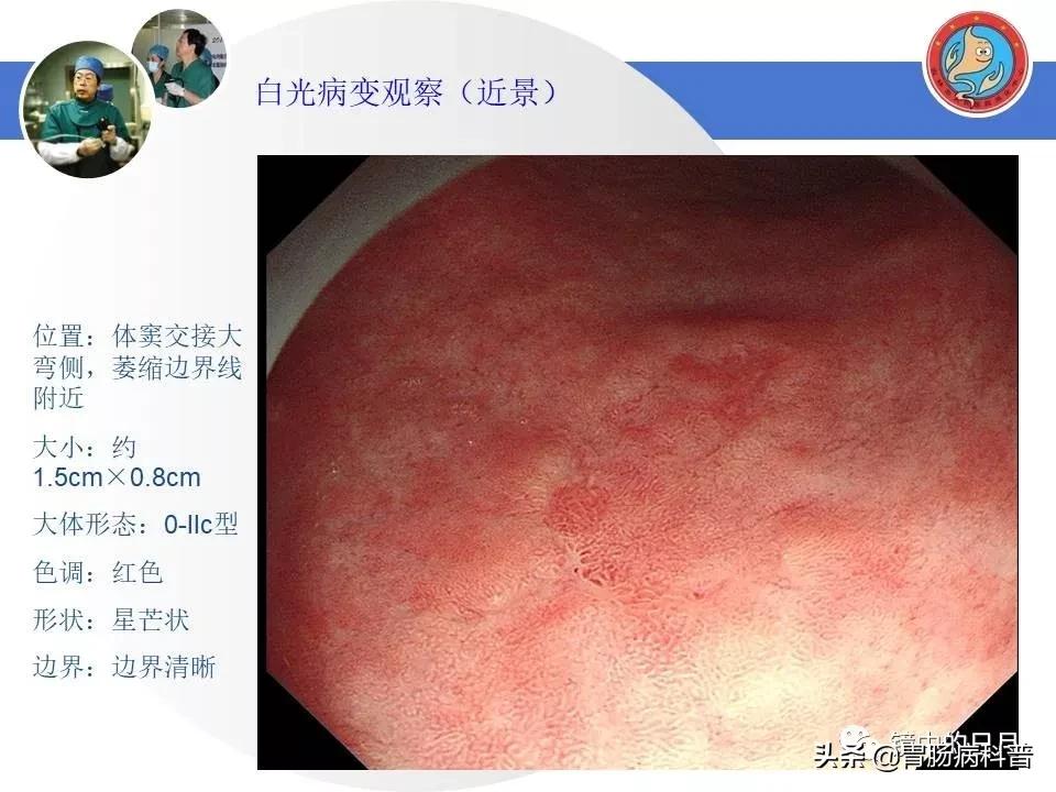 胃癌可以做内镜手术吗,早期胃癌内镜手术后追加外科手术