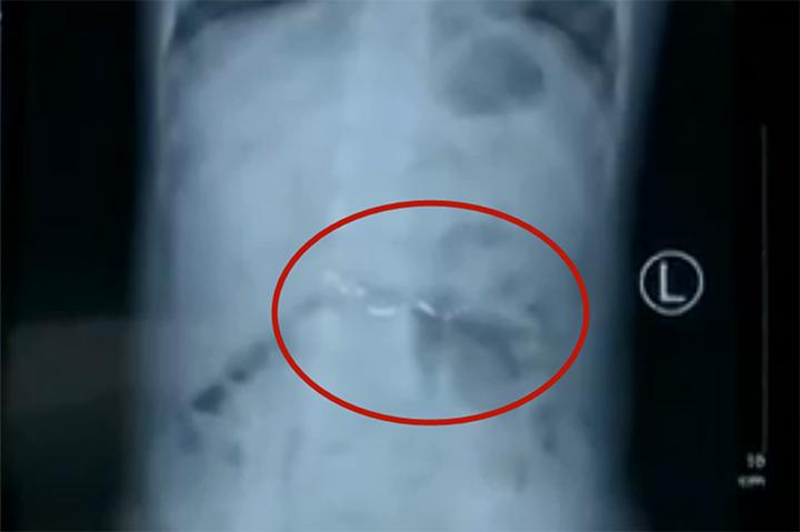 孩子咬破水银温度计怎么处理,孩子咬破水银体温计