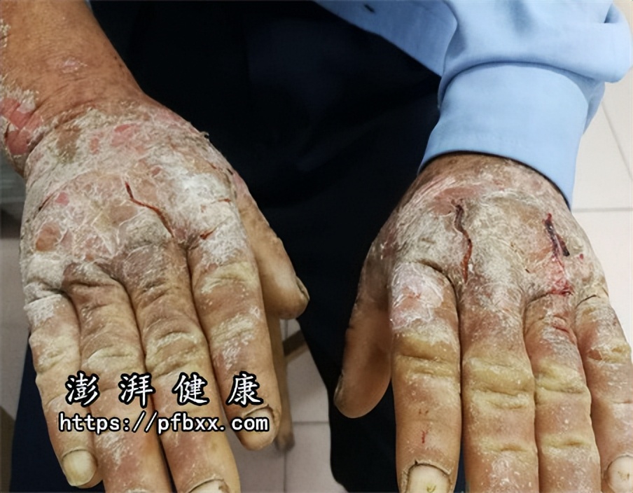 银屑病关节炎脚肿可以中药治疗吗,银屑病关节炎手指肿胀案例